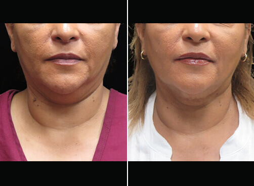 Chin Liposuction Before And After Front Image