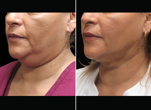 Chin Liposuction Before And After Quarter Image