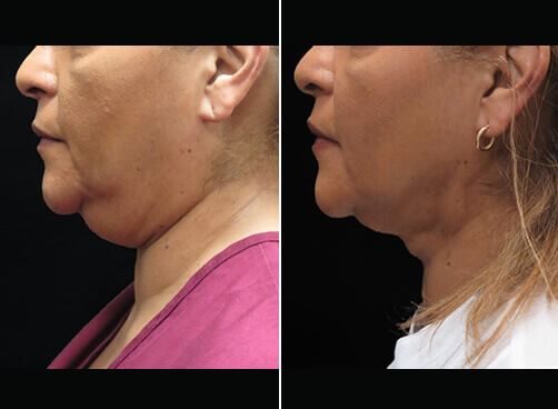 Chin Liposuction Before And After Side Image