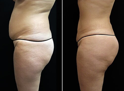 Lipo For Women Before And After