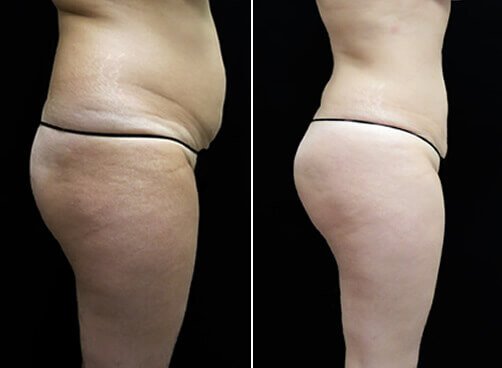 Female Lipo Before And After
