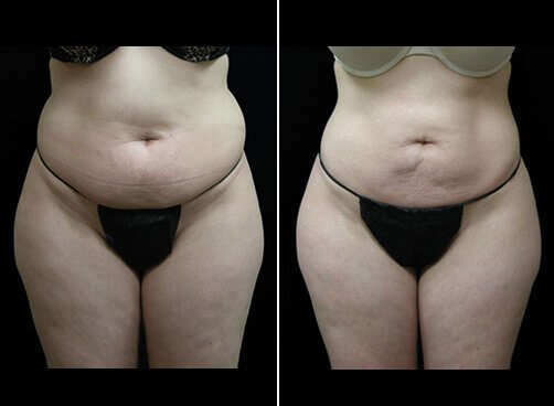 Female Liposuction Before And After Front Image
