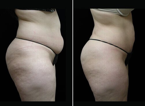 Female Liposuction Before And After Side Image