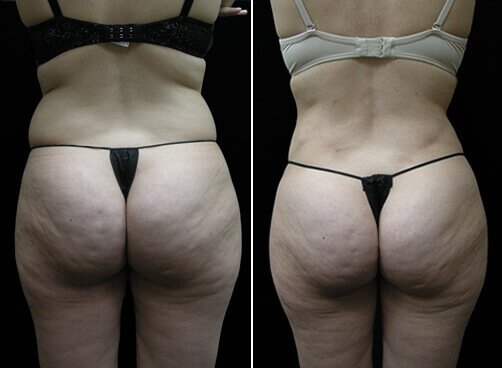 Female Liposuction Before And After Back Image