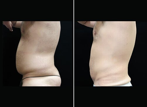 Liposuction For Men Before And After