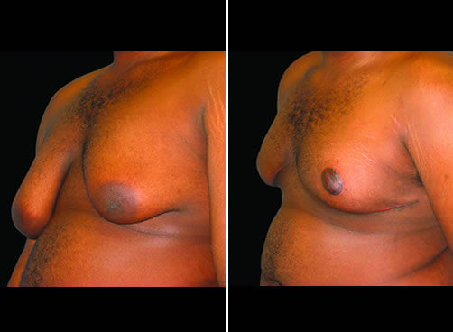 Male Breast Lipo Before And After Side Image