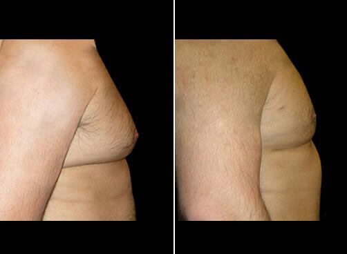Lipo For Men Before And After