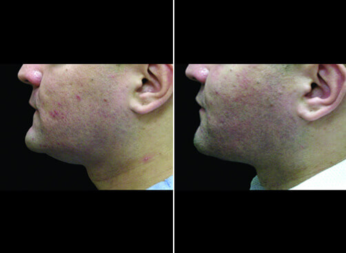 Neck Lipo For Men Before And After