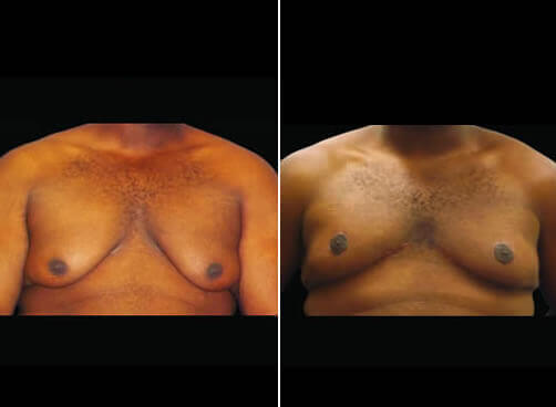 Gynecomastia Liposuction Before And After