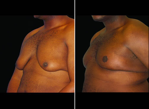 Gynecomastia Lipo Before And After