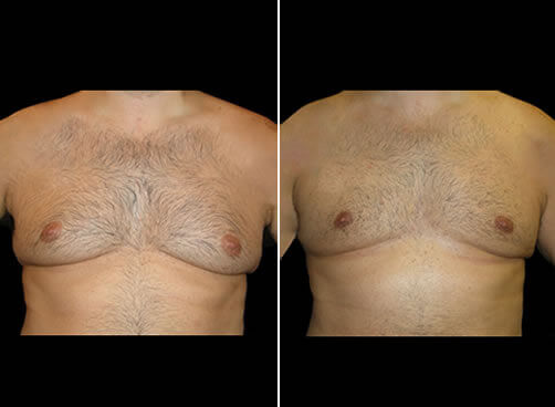 Gynecomastia Before And After Front View