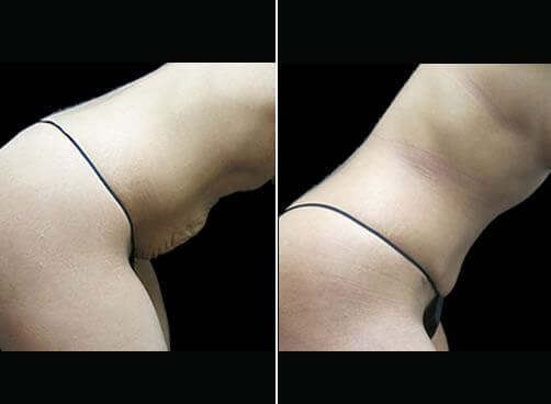 Liposuction And Mommy Makeover Before And After