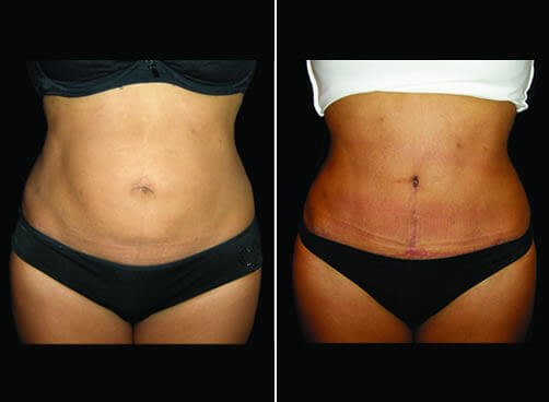 Lipo And Mommy Makeover Before And After Front View