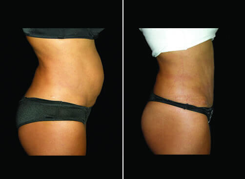 Lipo And Mommy Makeover Before And After Right Side Image