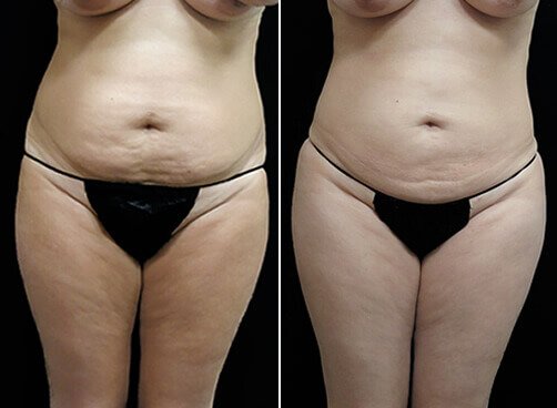Liposuction For Women Before And After