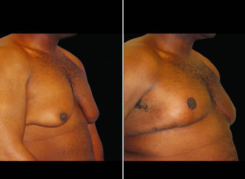 Male Liposuction Before And After Side View