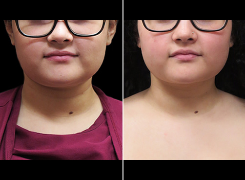 Chin Lipo Before And After Front View