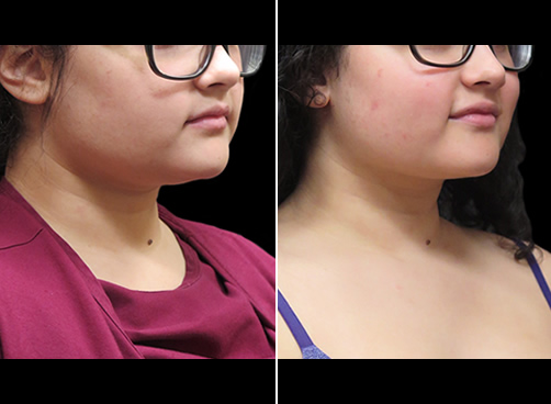 Chin Lipo Before And After Right Quarter View