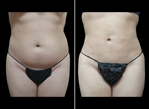 Lipo And Cellulaze Before And After Front Image