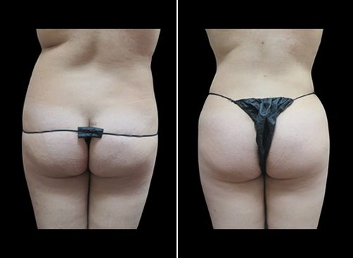 Lipo And Cellulaze Before And After Back Image