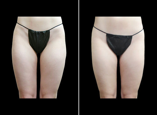 Thigh Liposuction Results