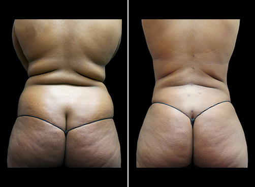 Abdominal Lipo Before And After Back Image