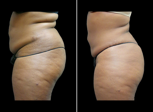Abdominal Lipo Before And After Left Side Image