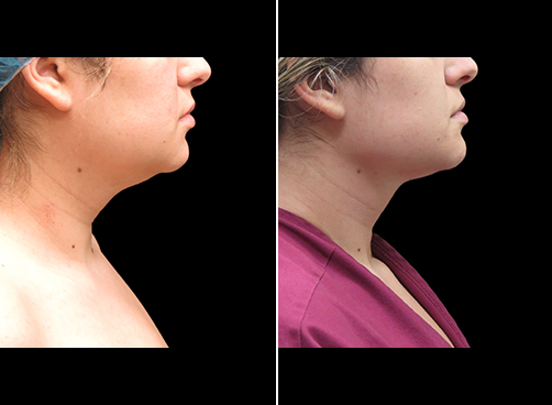 Before And After Neck Liposuction Right Side View