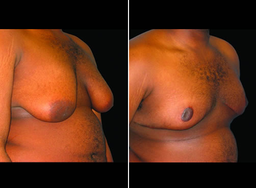 Male Breast Lipo Before And After Quarter Image