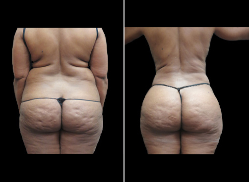 Liposuction Treatment For Women Before & After