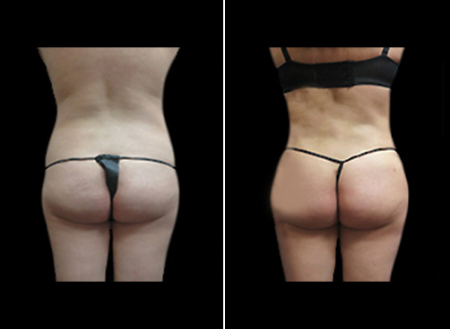 Female Lipo Procedure Before & After