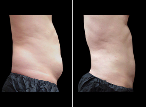 Lipo Surgery For Men Before & After