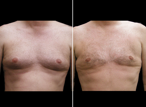 Liposuction Treatment For Men Before & After