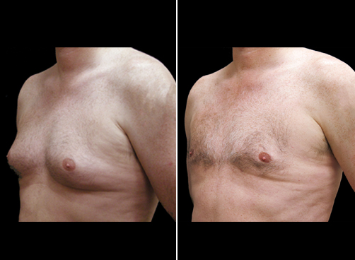 Before And After Liposuction Treatment For Men