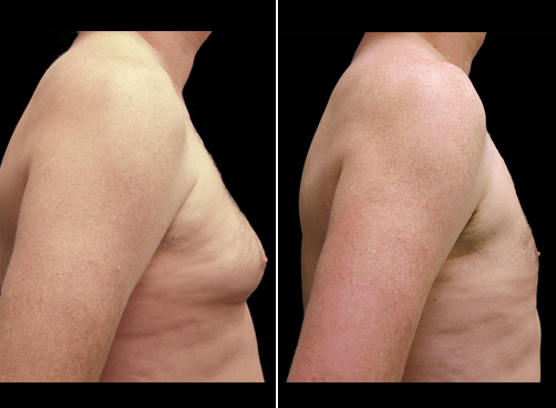 Before & After Liposuction Treatment For Men