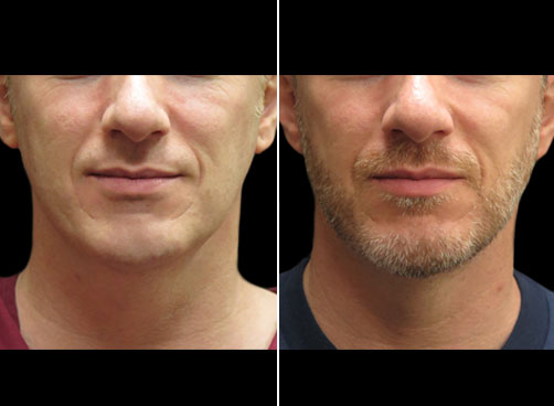 Before And After Laser Neck Lift