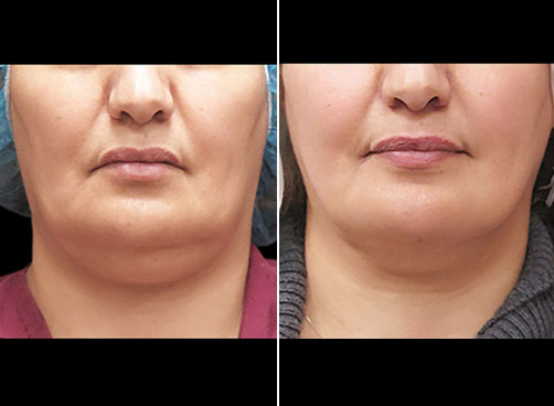 Laser Neck Lift Surgery Before And After