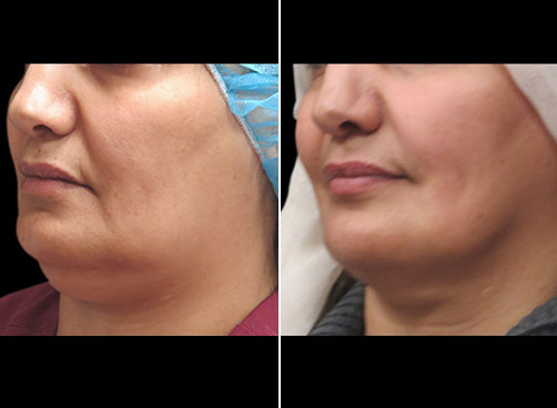 Laser Neck Lift Surgery Before & After