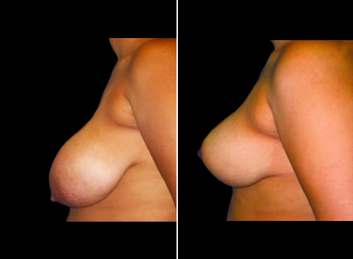 Lipo And Breast Reduction Before And After