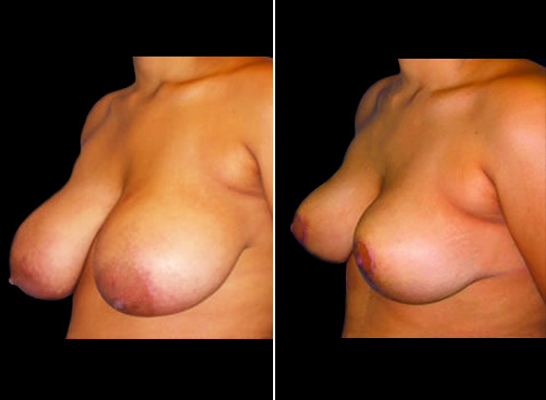 Lipo And Breast Reduction Before & After