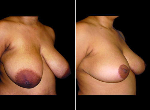 Liposuction And Breast Reduction Before And After