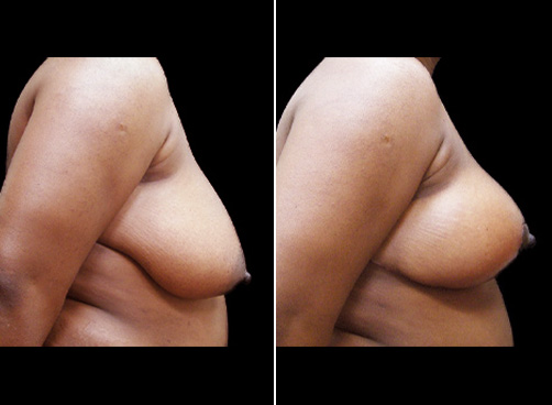 Before & After Lipo Surgery & Breast Reduction