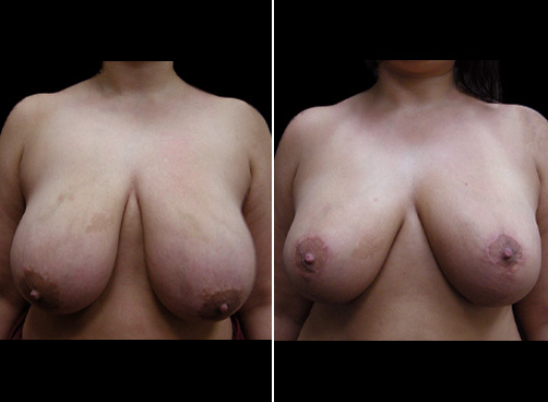 Liposuction Surgery And Breast Reduction Before And After