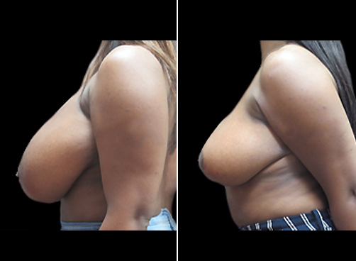 Lipo And Breast Reduction Surgery Before And After