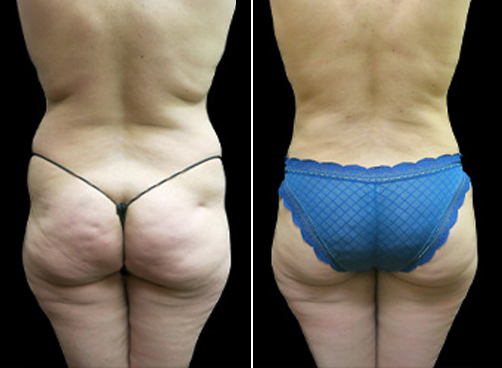 Liposuction Surgery And Mommy Makeover Before And After