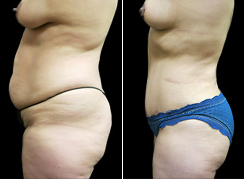 Lipo And Mommy Makeover Surgery Results