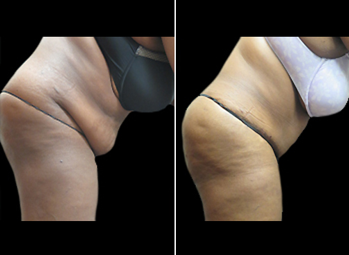 Liposuction Treatment & Mommy Makeover Before And After
