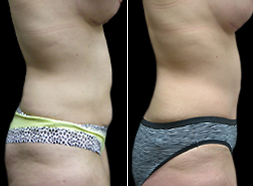 Lipo Treatment And Mommy Makeover Before & After