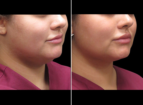 Laser Necklift Surgery Before And After