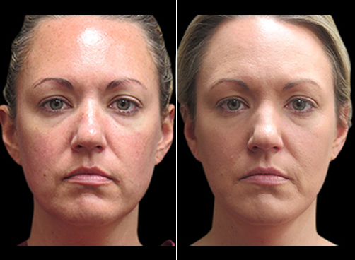 Before And After Laser Necklift
